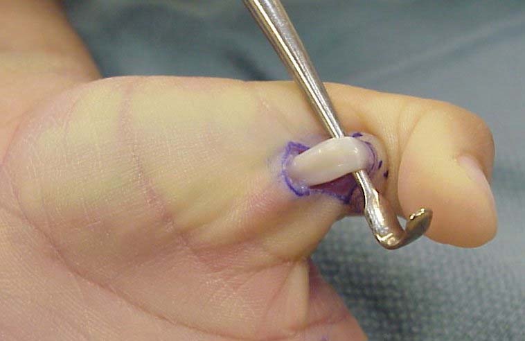 Trigger Finger Release