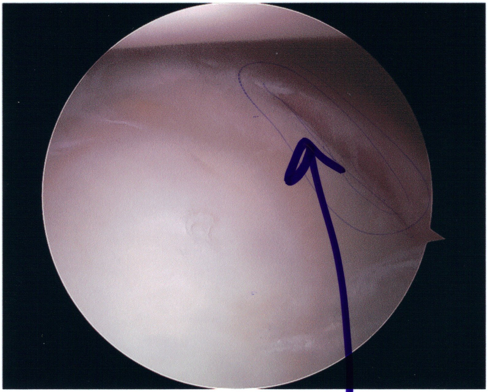 Anterior Shoulder Stabilisation