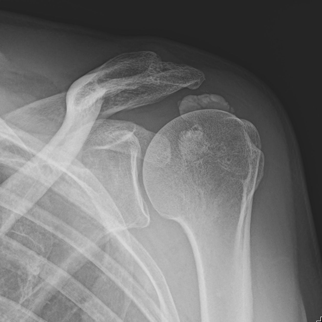 Calcific Tendinitis