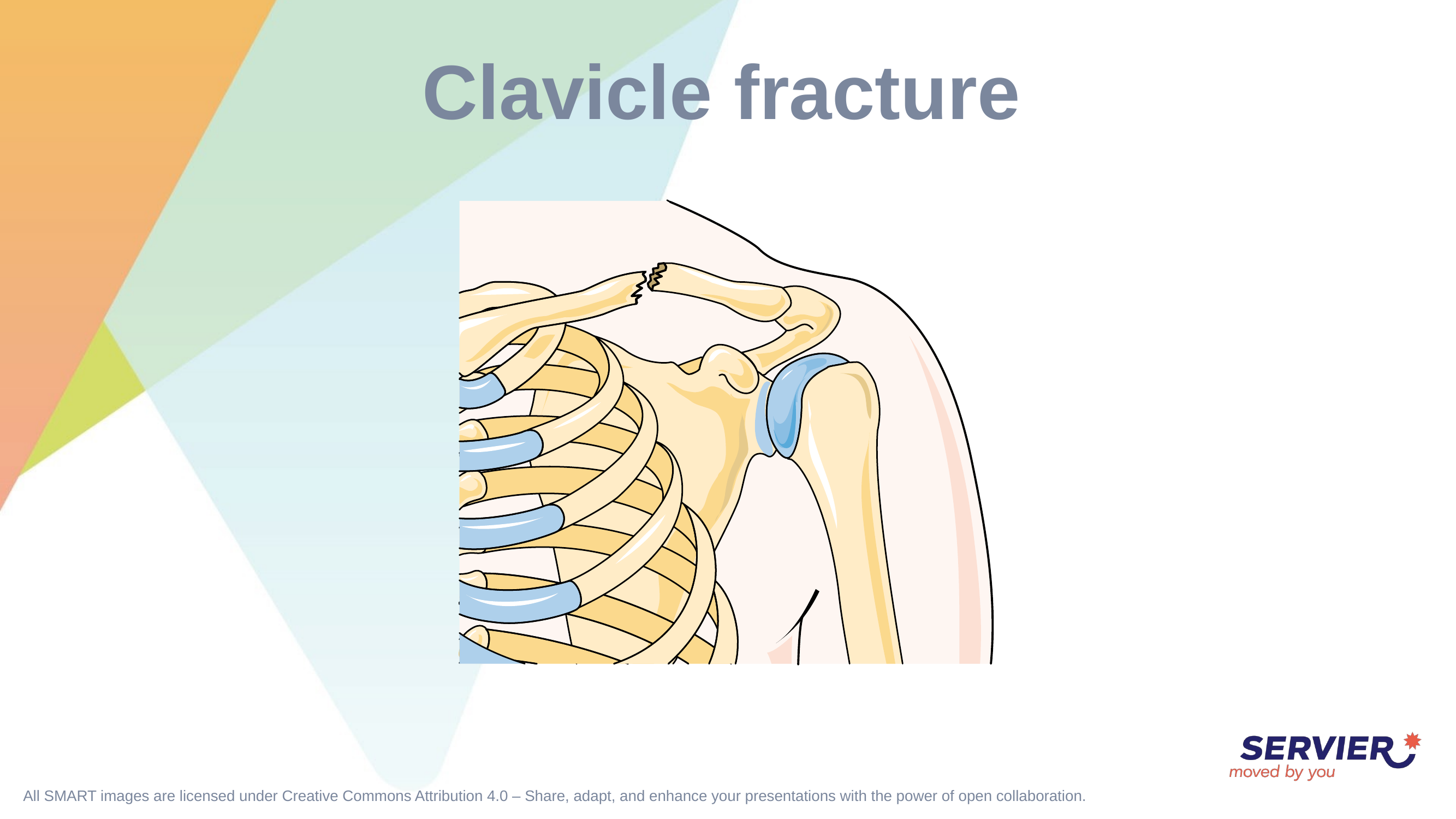 Clavicle Fracture Fixation