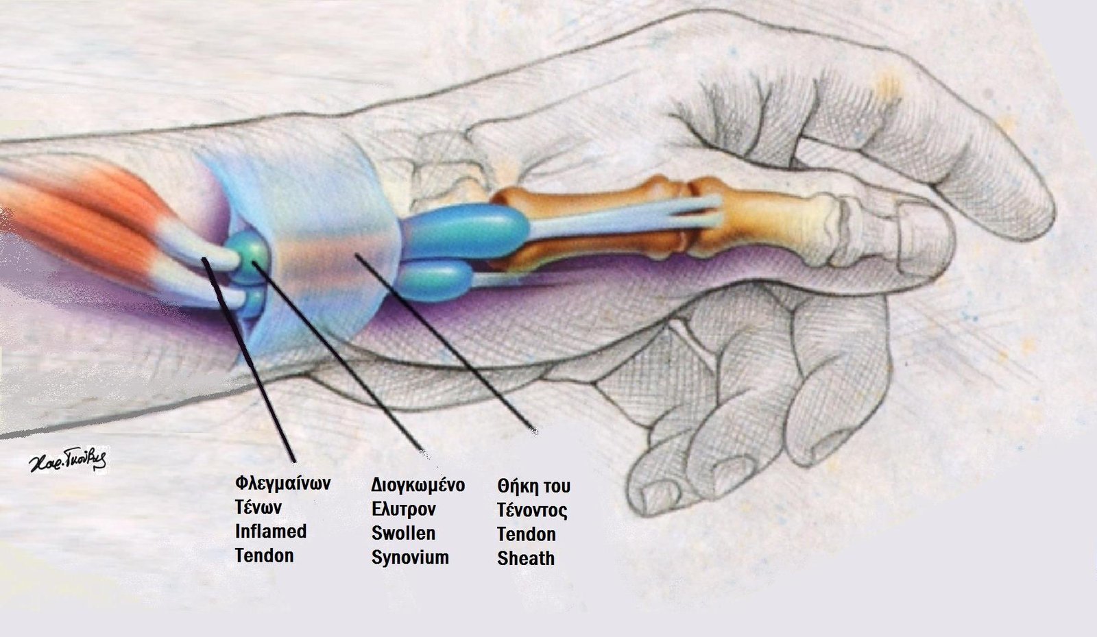 De Quervain's Tenosynovitis