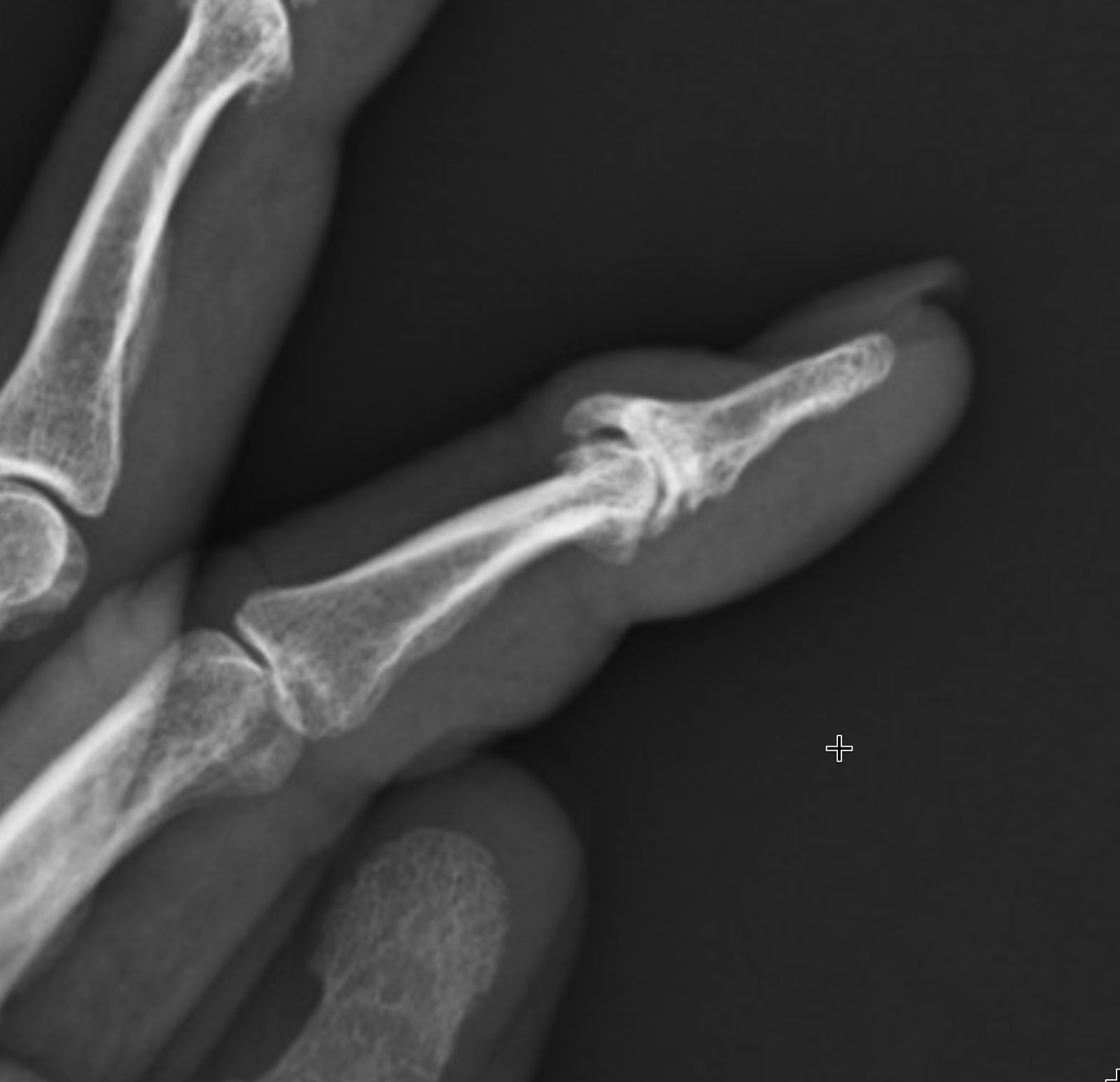 X-ray of a finger showing distal interphalangeal joint arthritis, with narrowed joint space at the tip and a small bony spur on the side.
