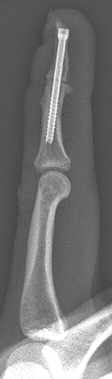 Lateral X-ray of a left hand showing a fused distal interphalangeal joint.