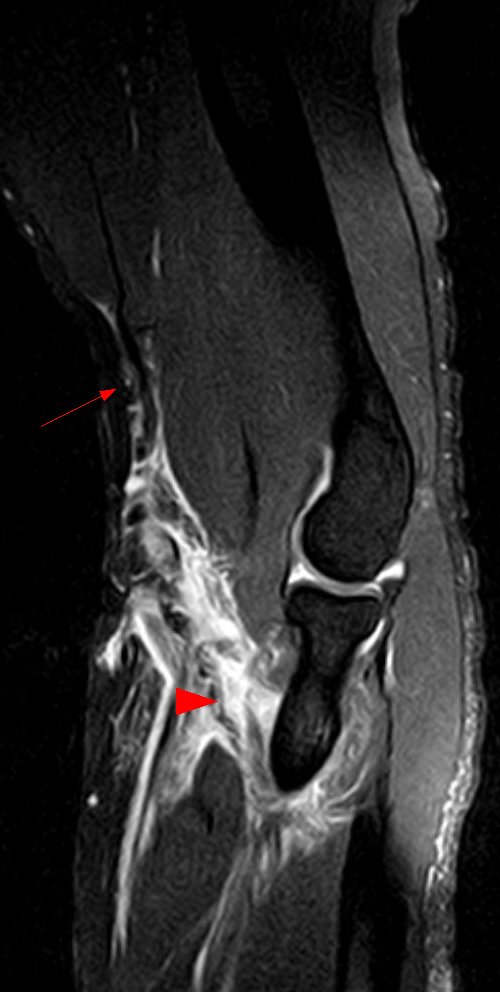 Distal Biceps Repair