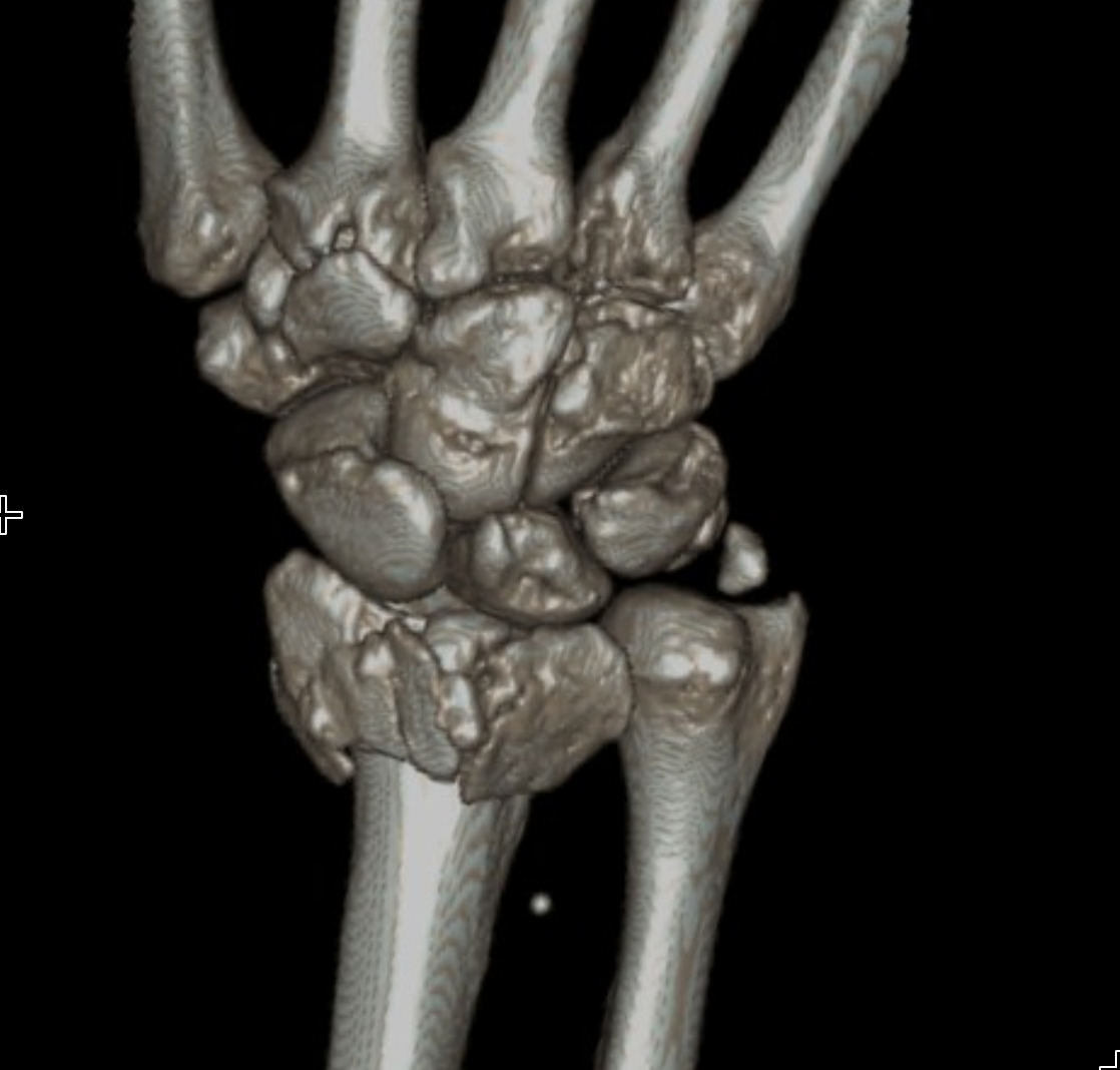 X-ray of a wrist with a displaced fracture at the end of the radius bone, the most common adult fracture pattern.