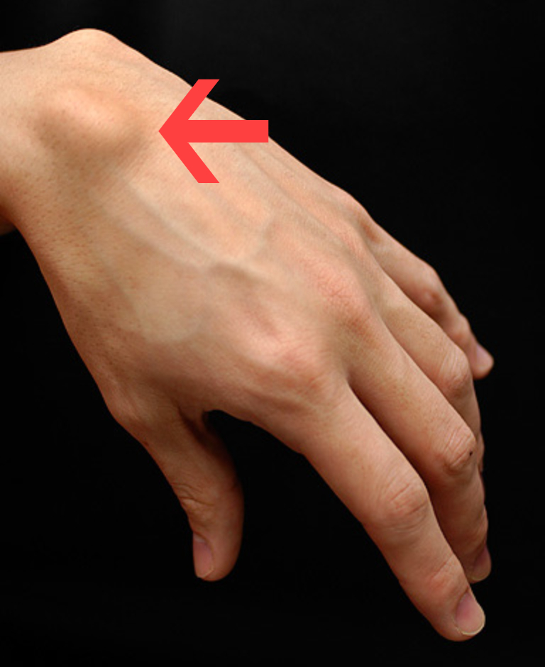 Wrist Ganglion Excision