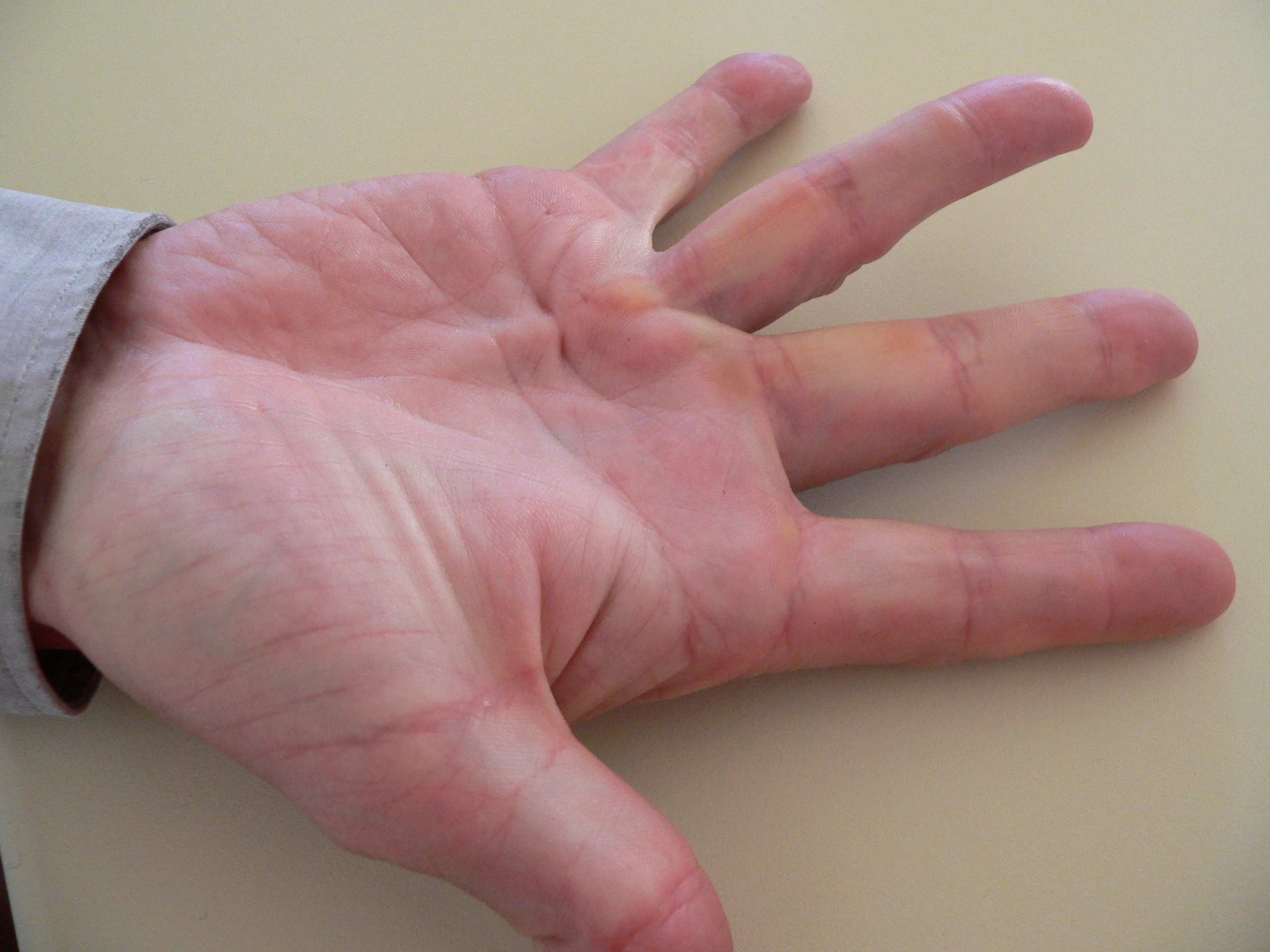 Dupuytren's Fasciectomy