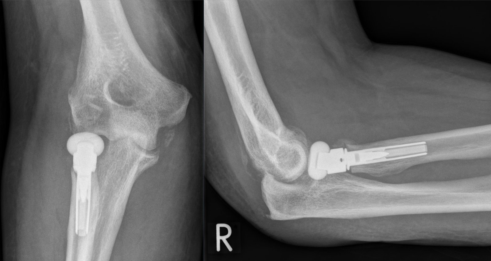 X-ray of an elbow with prosthesis