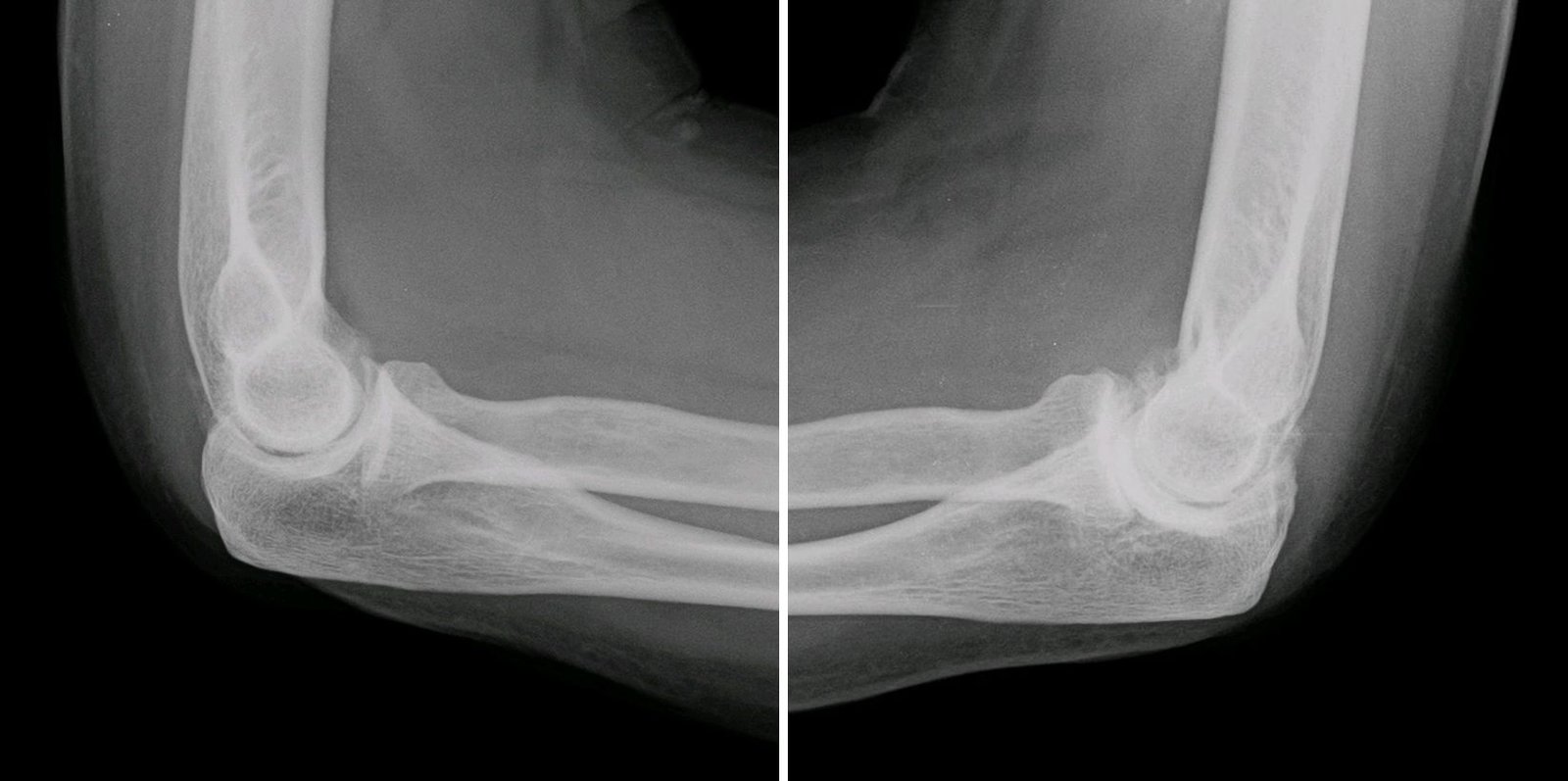 Elbow Osteoarthritis