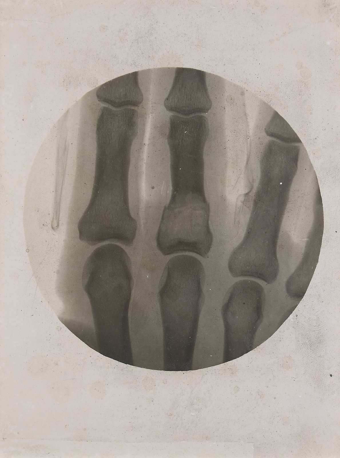 X-ray showing a phalanx fracture