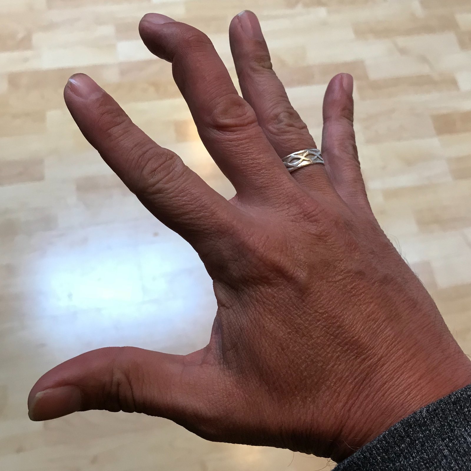 Fingertip Injuries