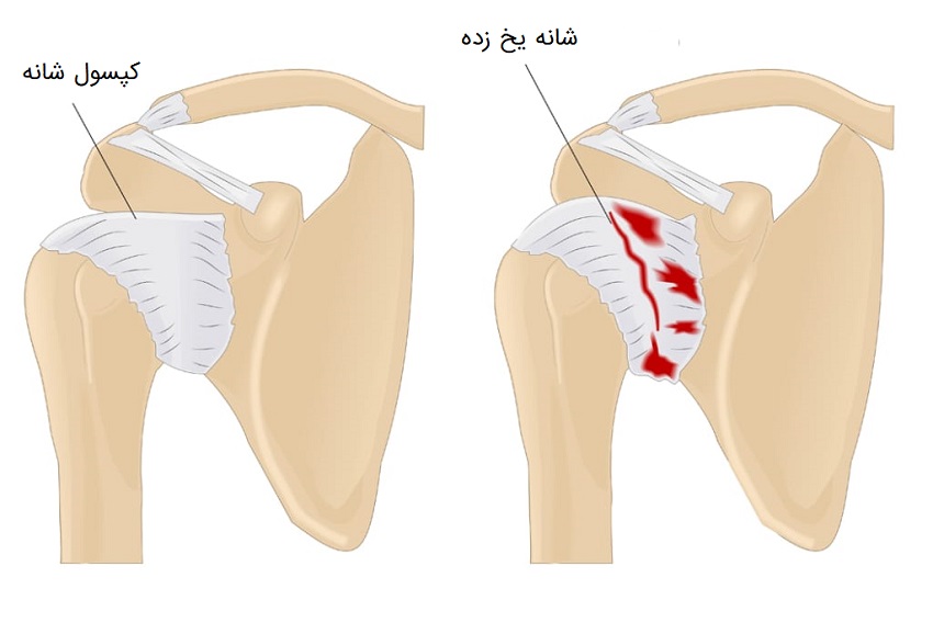 Frozen Shoulder