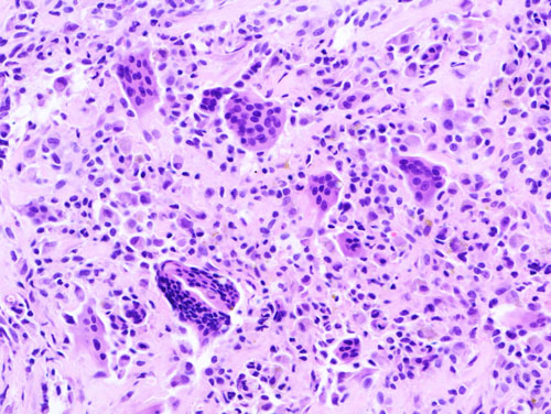 Giant Cell Tumour of Tendon Sheath