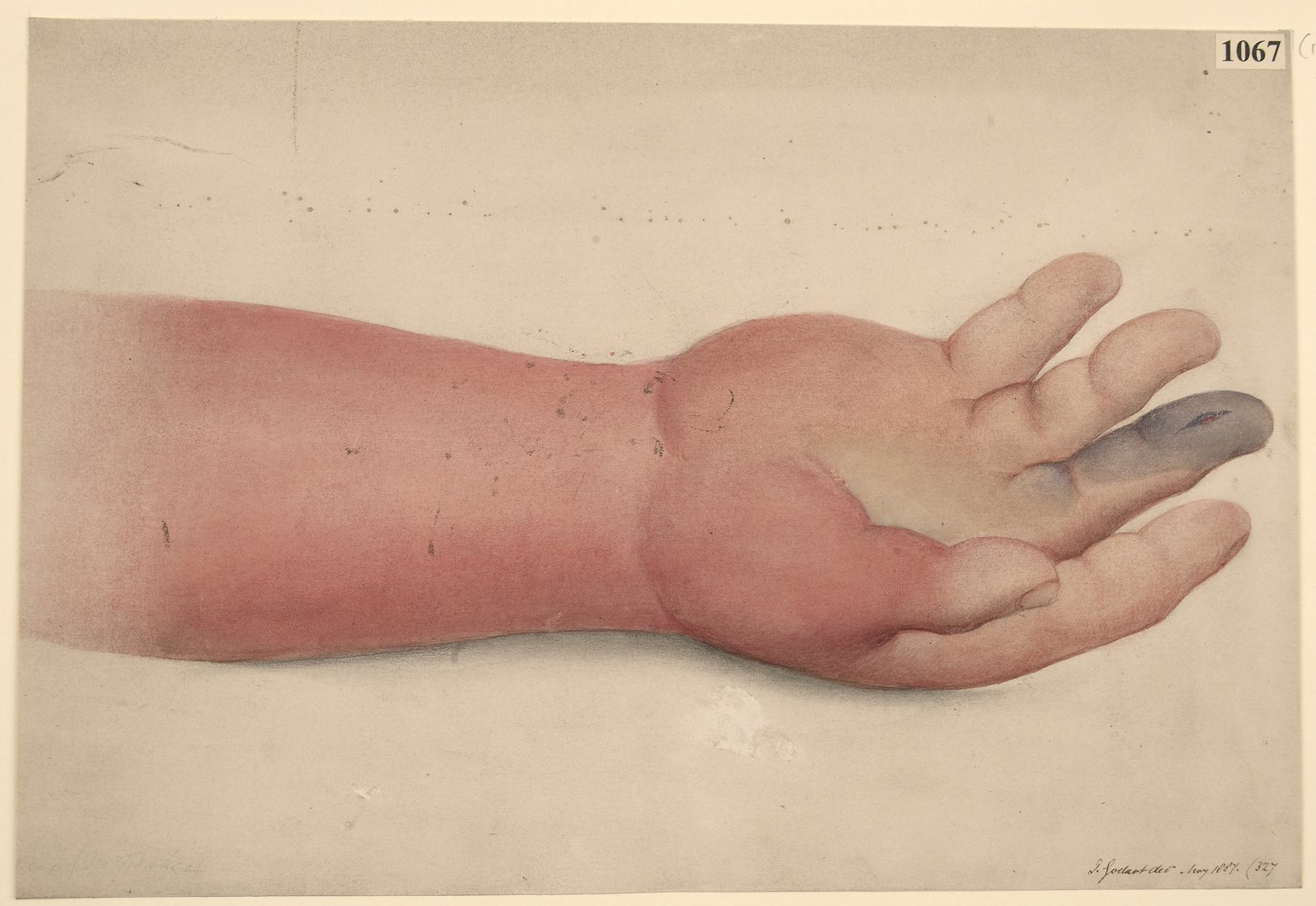 Hand Infections