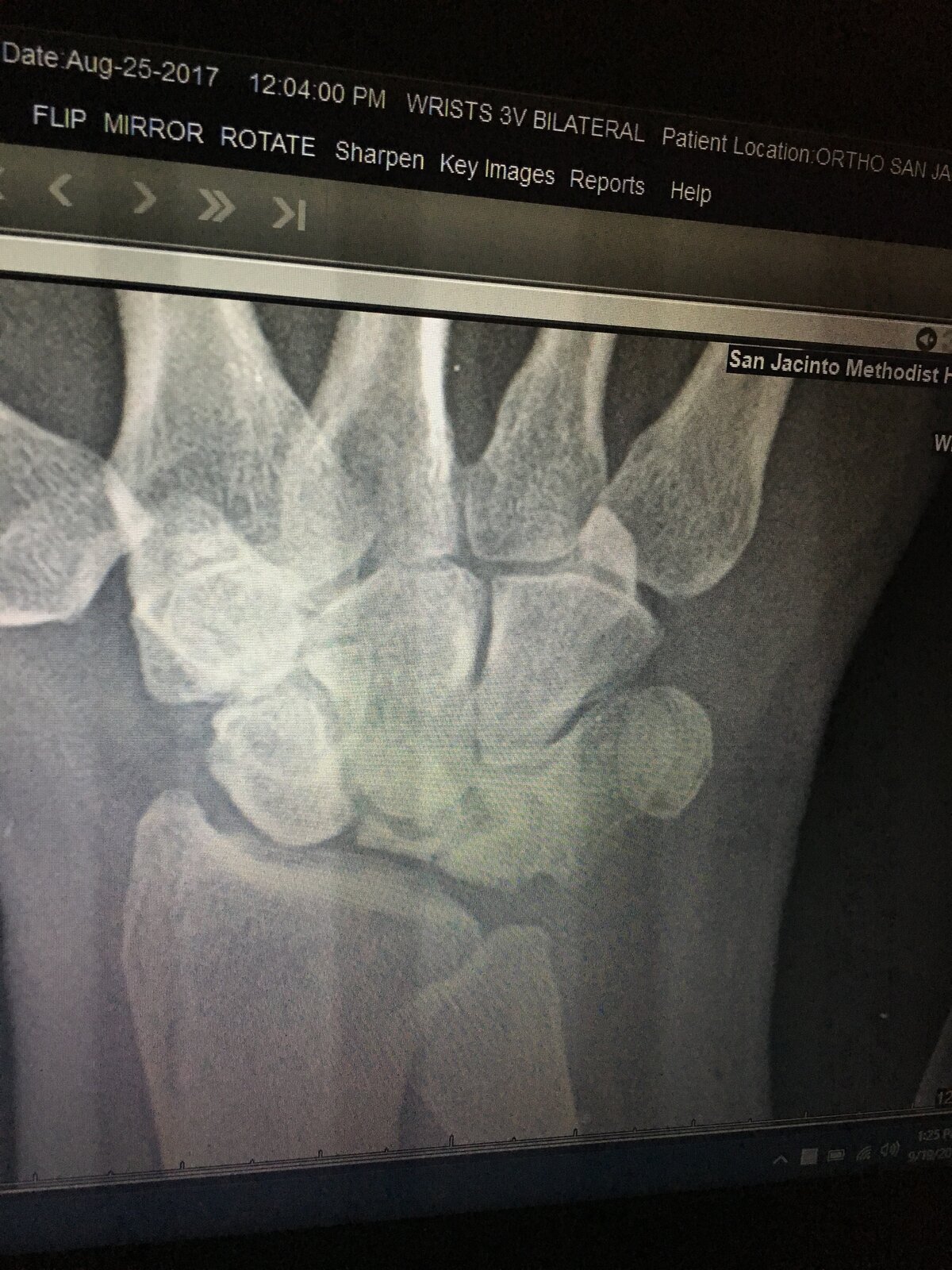 Kienböck's Disease