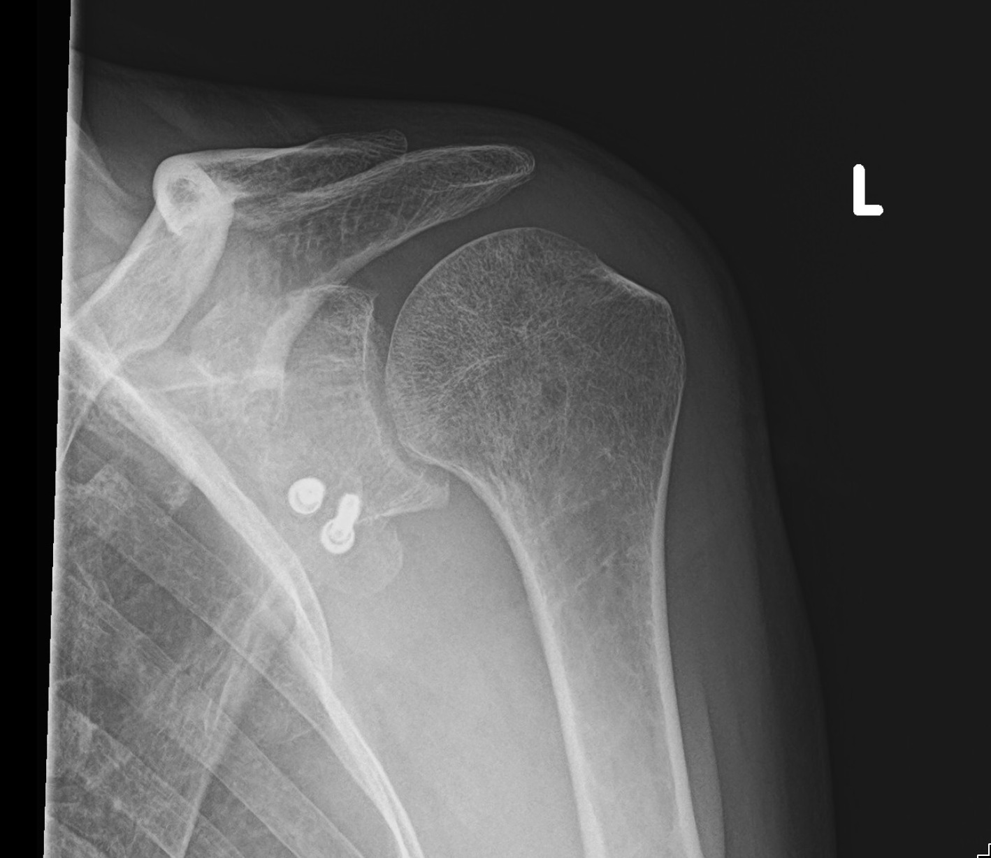 X-ray of a left shoulder after a Latarjet procedure, showing two screws fixing a transferred coracoid bone block to the front of the shoulder socket.