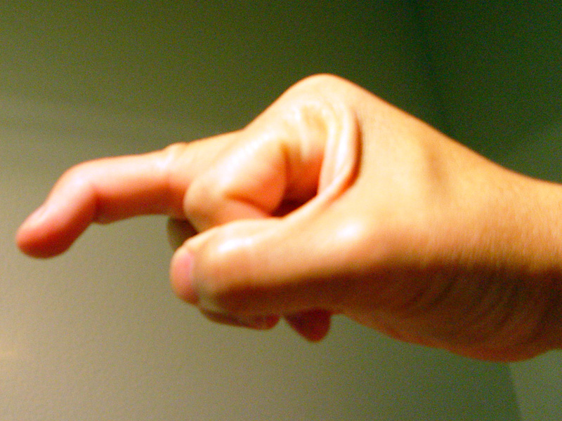 Clinical photograph of mallet finger showing the drooping fingertip.