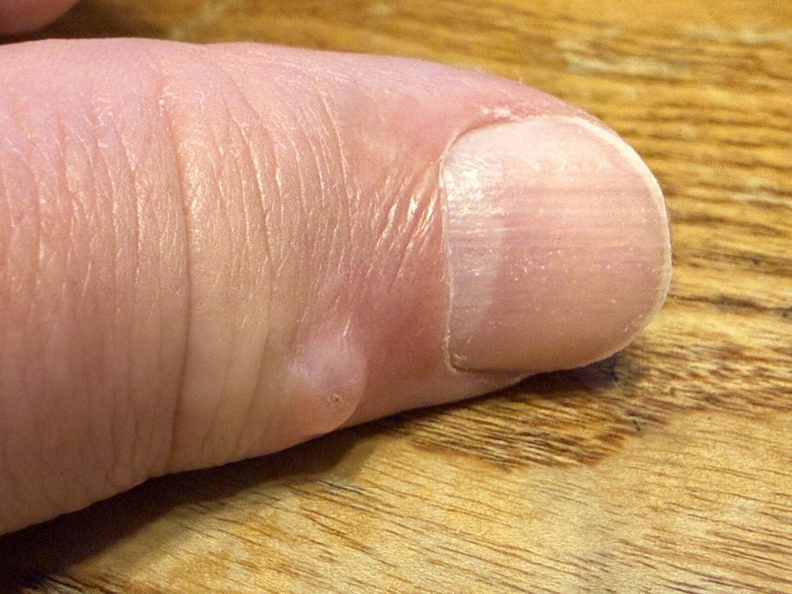 Clinical photograph of a mucous cyst on the thumb at the end joint.