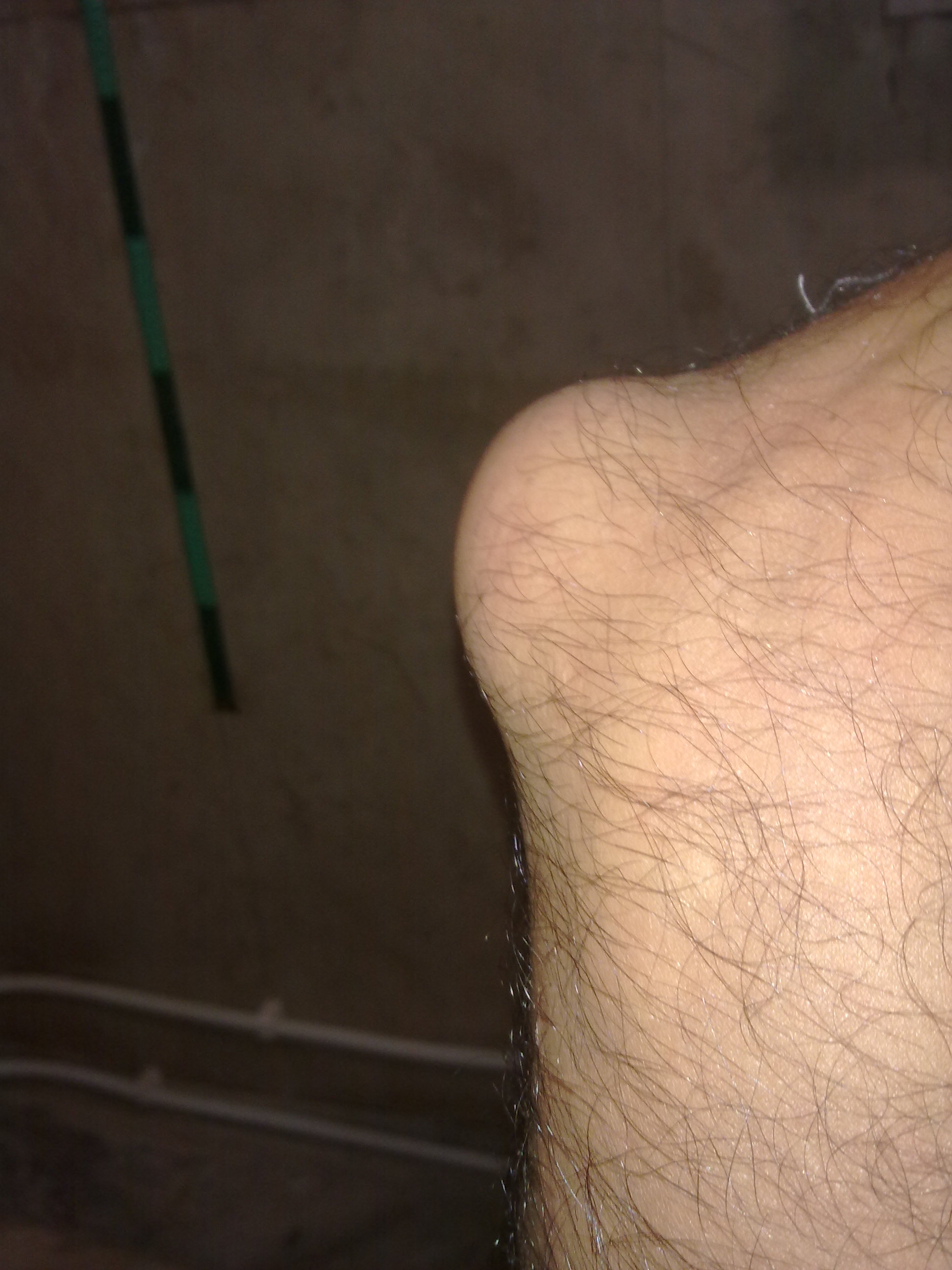 Clinical photograph of an elbow with olecranon bursitis showing a swollen lump over the tip of the elbow.
