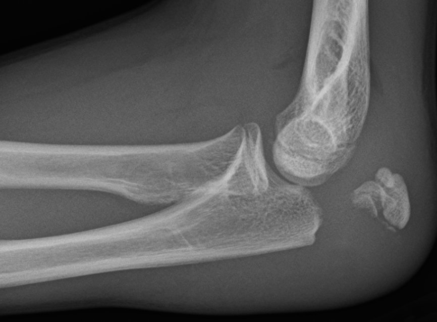 Olecranon Fracture