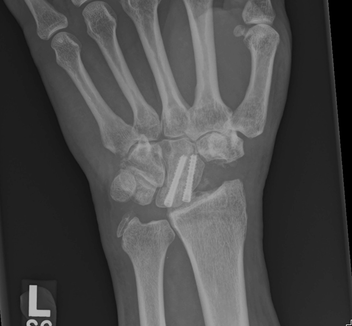 Partial Wrist Fusion