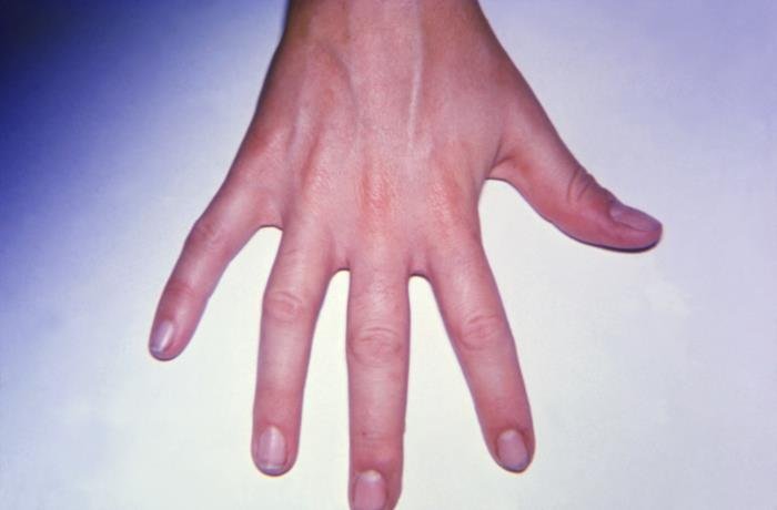 PIP Joint Arthritis