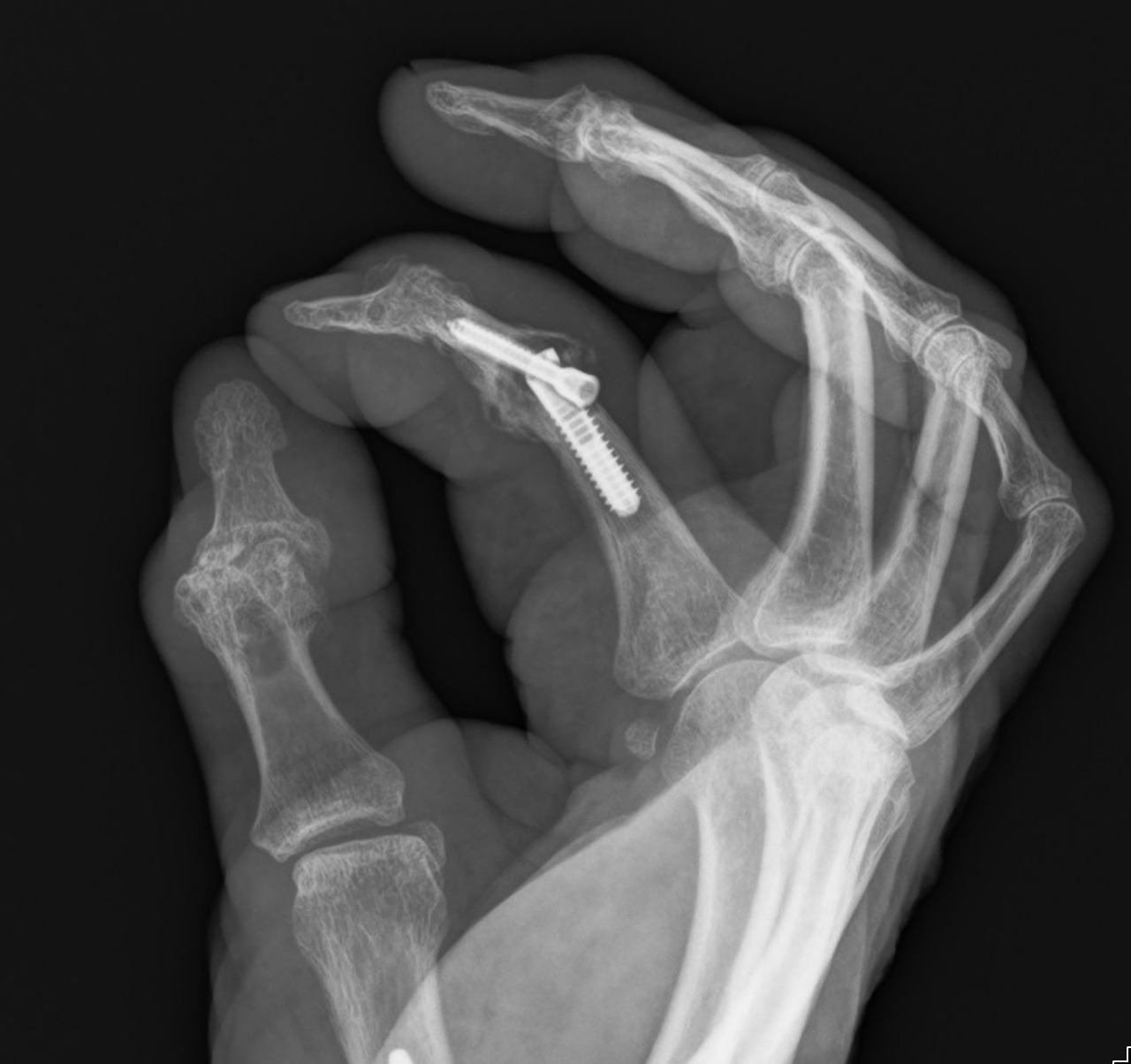 PIP Joint Fusion