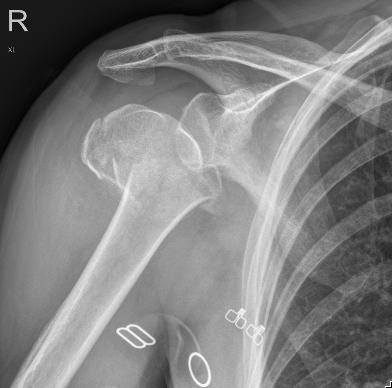 Proximal Humerus Fracture