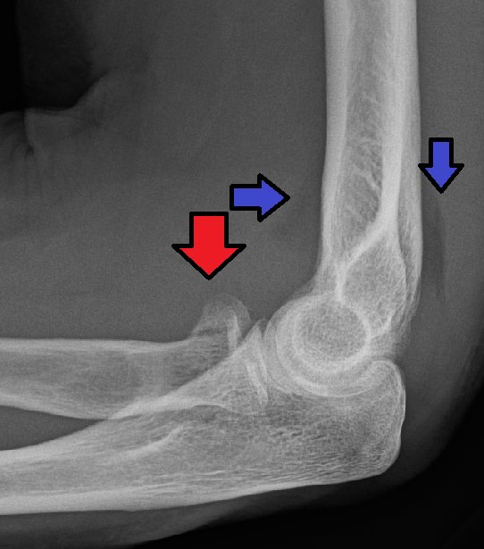 Radial Head Fracture