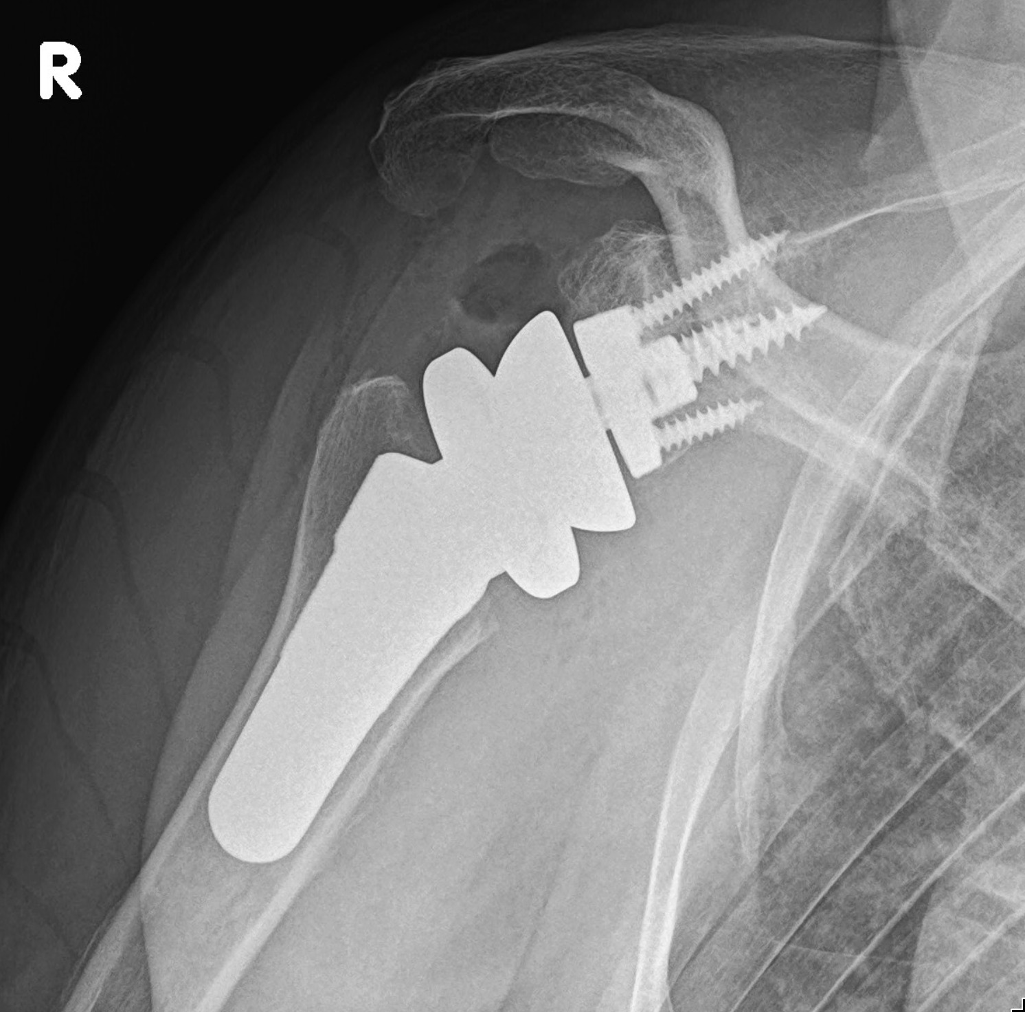 Reverse Shoulder Arthroplasty