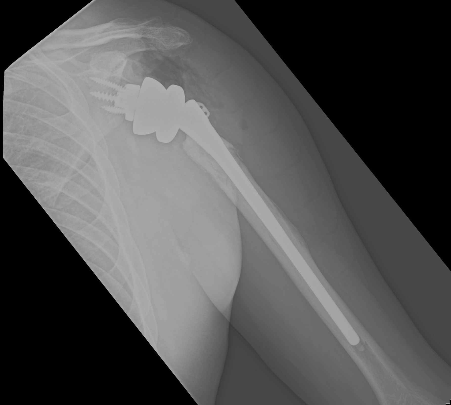 Revision Shoulder Replacement