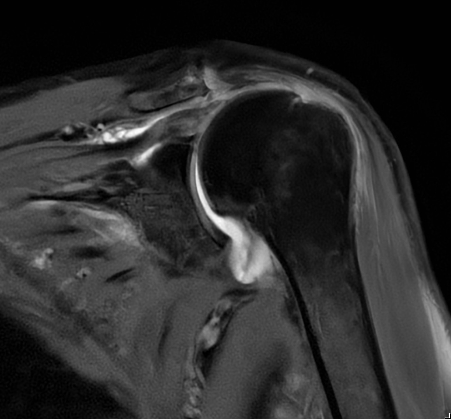 Rotator Cuff Disorders