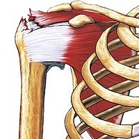 Rotator Cuff Repair
