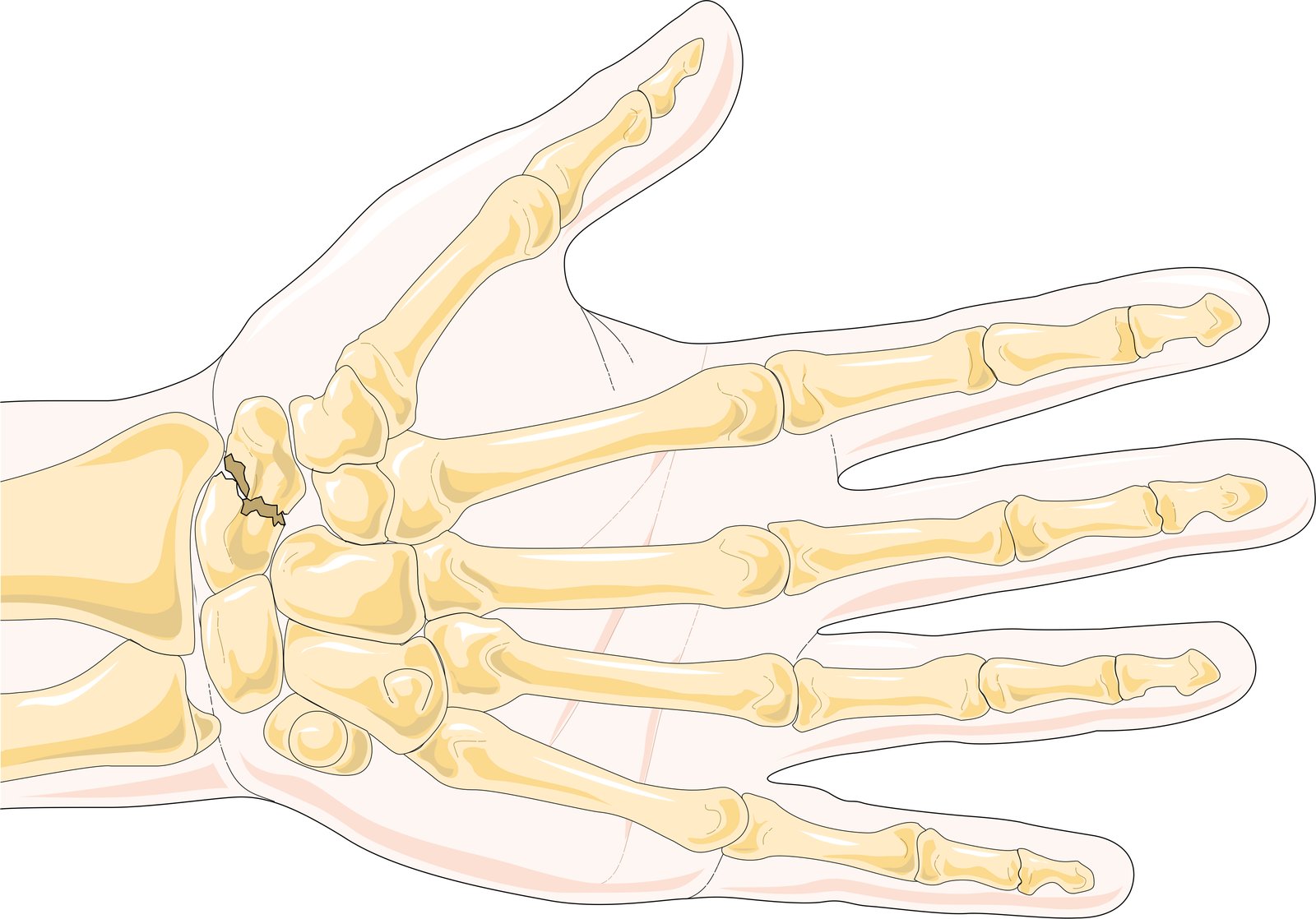 Scaphoid Fixation