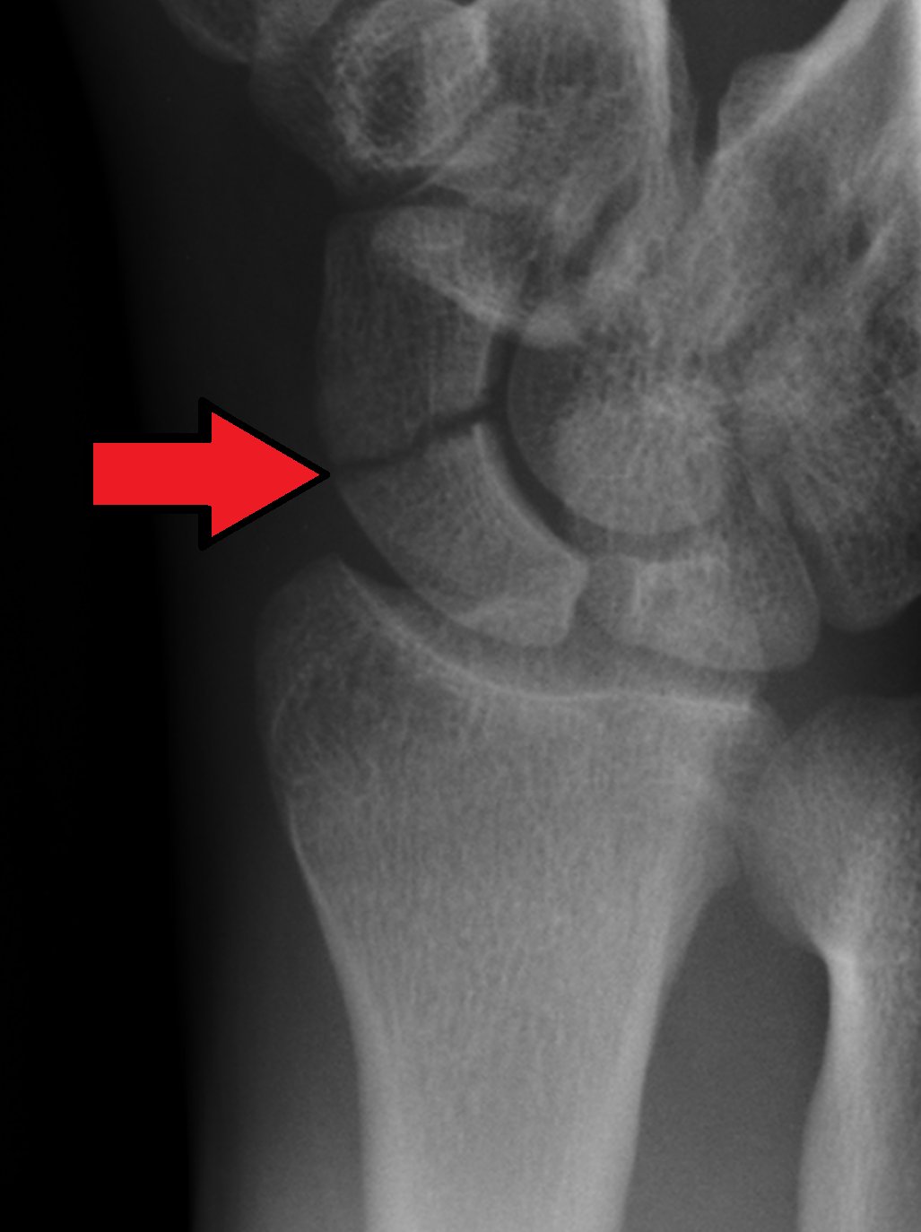 Scaphoid Fracture