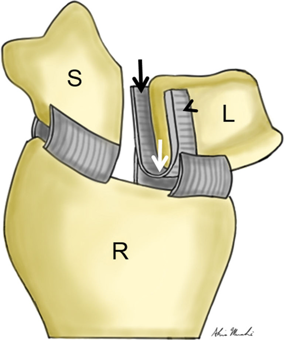 Wrist Ligament Injuries