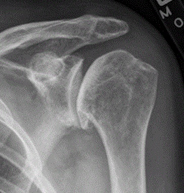 Shoulder Arthritis
