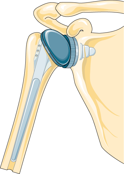 Total Shoulder Arthroplasty