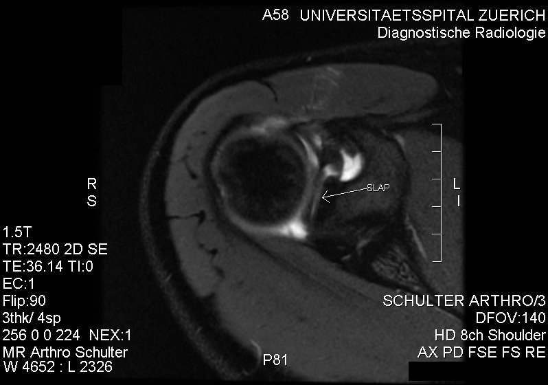 MRI of a SLAP lesion