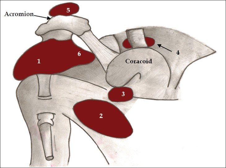 Subacromial Decompression