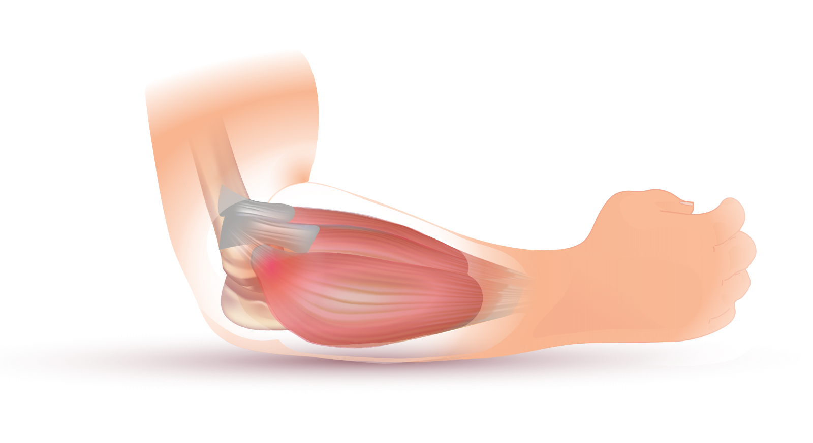 Tennis Elbow Release