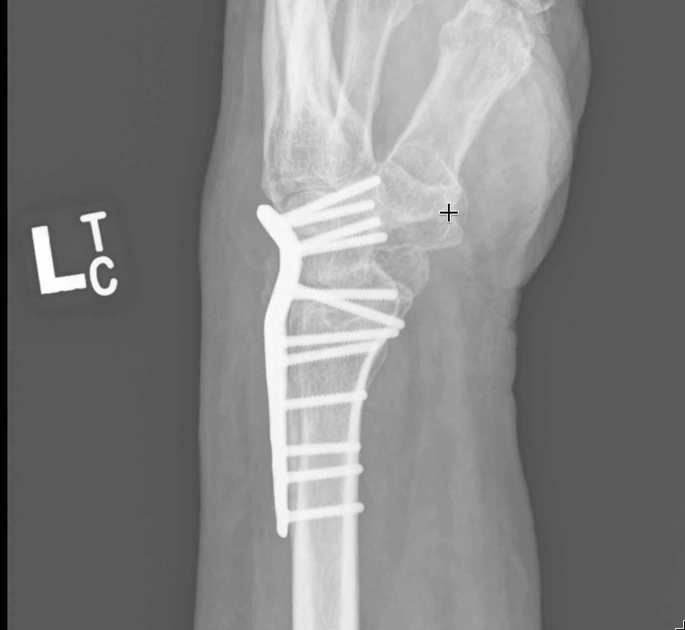 Total Wrist Fusion