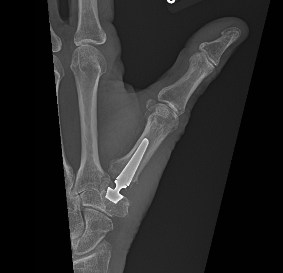 X-ray of a thumb after a Touch dual-mobility CMC joint replacement, with the metal stem in the thumb metacarpal and the cup seated in the trapezium.