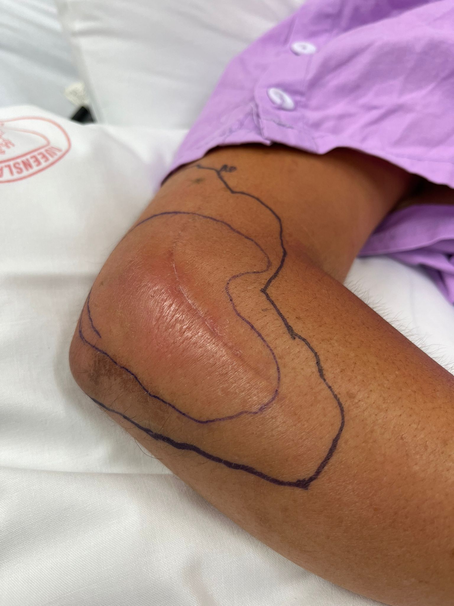 Forearm with surgical pen marking the perimeter of an area of redness around a healing wound.