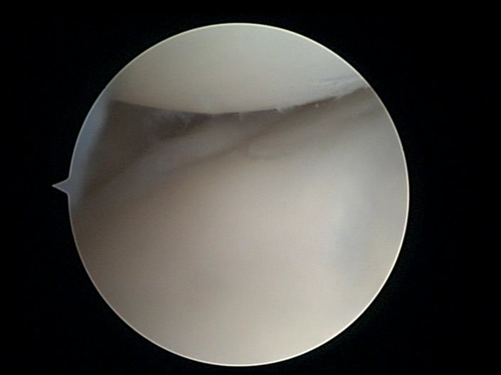 Diagram of wrist arthroscopy