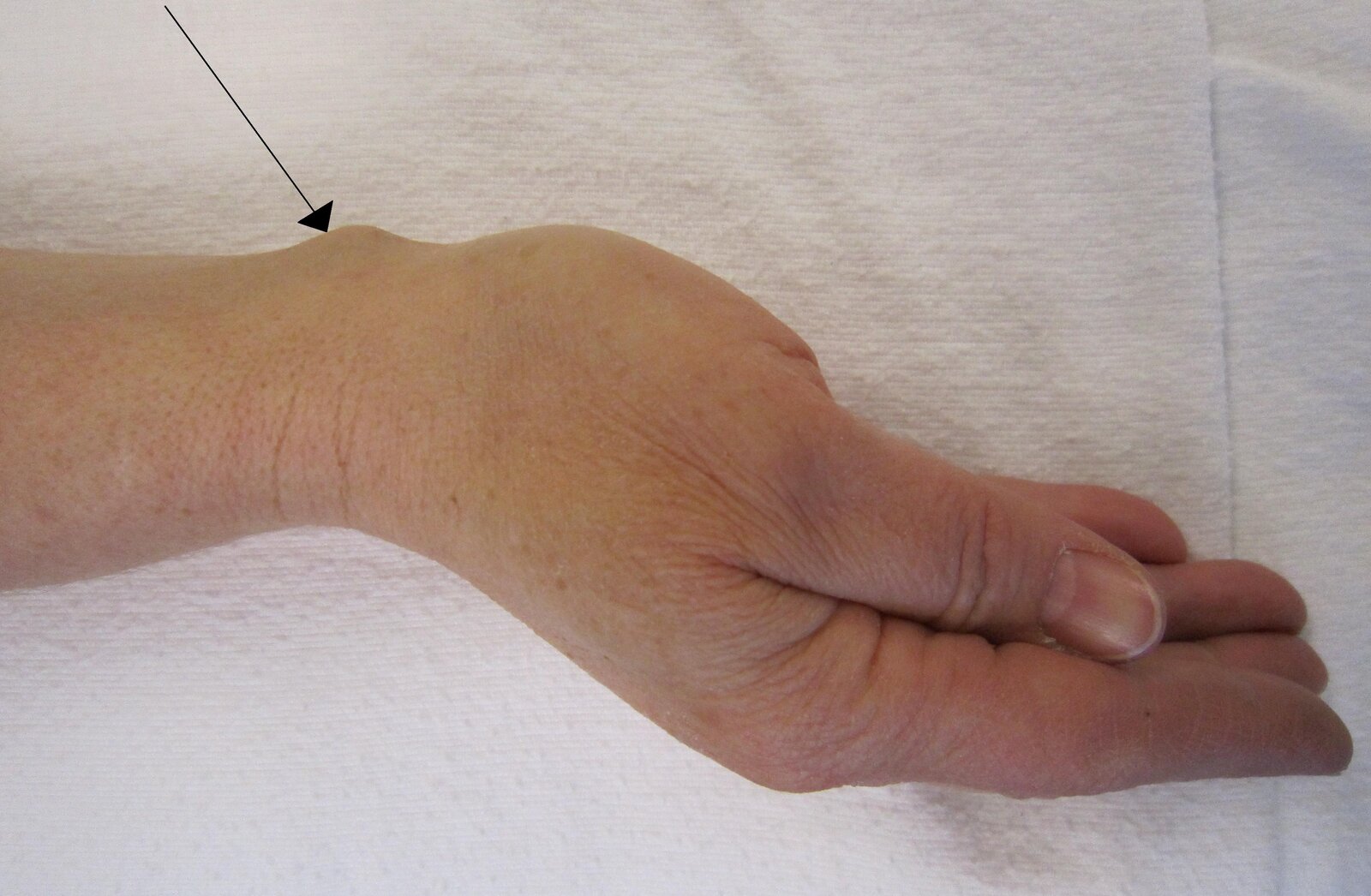 Wrist Ganglia